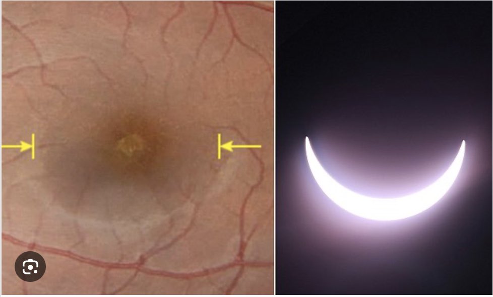 Reminder to not look into the sun directly, not even briefly – and not even when covered ~99%. There have been unfortunate instances w/ the eclipse burnt into the retina (permanently). Do not use normal sunglasses but only approved eclipse viewing glasses. science.nasa.gov/eclipses/safet…