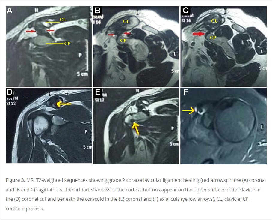 Does the coracoclavicular ligament heal after A-C joint stabilization surgery? This Egyptian study shows not only improvement in PROs and CC distance but also MRI evidence of CC ligament healing! #Tightrope #ACseparation Read more into this study here! ow.ly/gXw450RaQl8