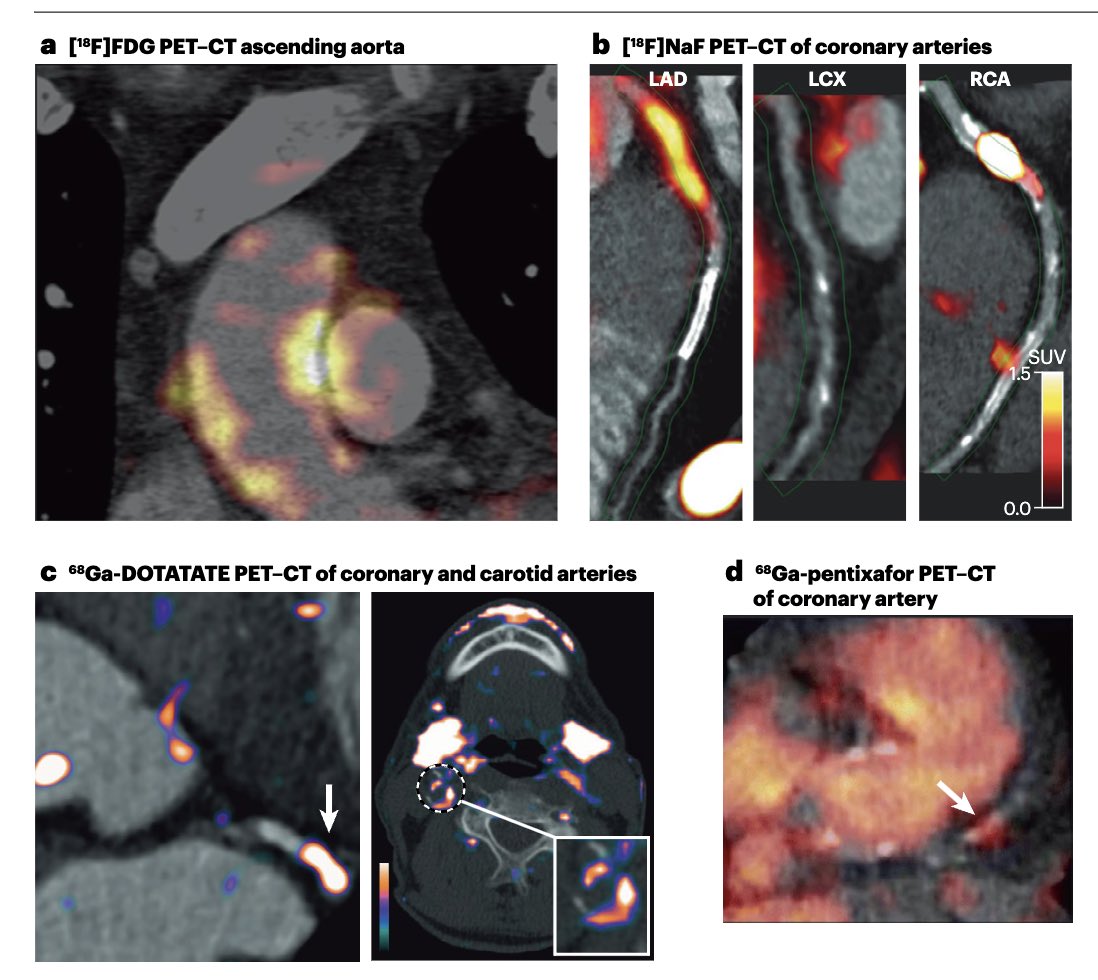 Now online! BMEII investigators review the latest developments in the world of atherosclerosis PET imaging in Nature Reviews Cardiology. Click here for full access to the article: rdcu.be/dDF85 @mandyvanleent @zahifayad @alexm_official