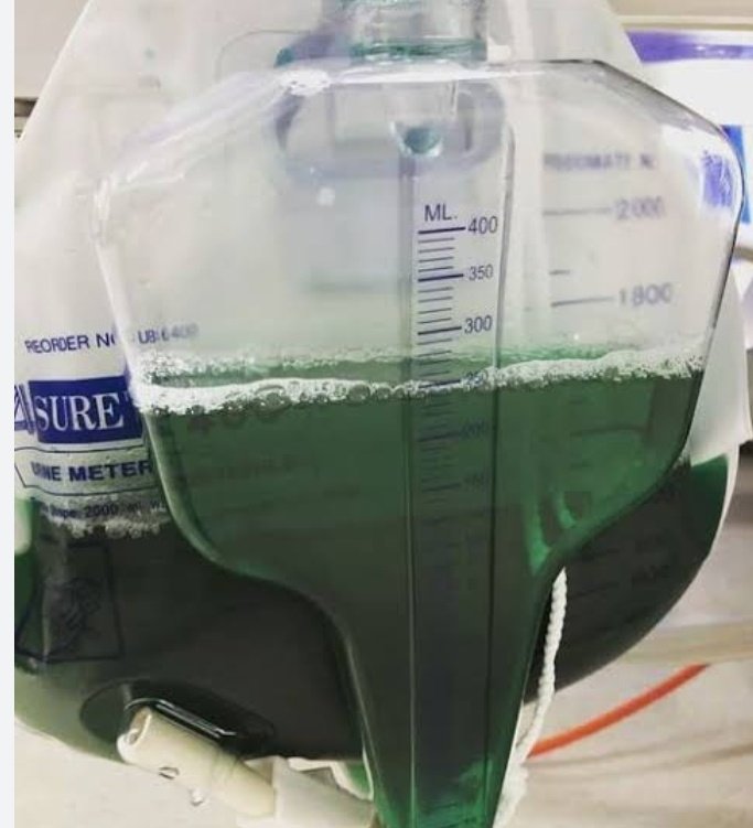 🟣𝘾𝙇𝙄𝙉𝙄𝘾𝘼𝙇 𝙎𝘾𝙀𝙉𝙀𝙍𝙄𝙊:-

📙With urine turning #green on ferric chloride test ,the diagnosis is:-

A) Phenylketonuria 
B) Alkaptonuria 
C) Glutaric aciduria 
D) Rifampicin drug toxicity 

#medx
#medEd
#medtwitter