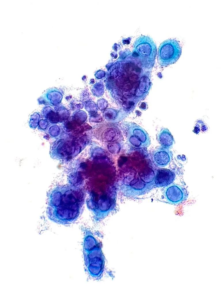 Cervical Pap test revealing squamous cells showing what viral cytopathic effect? Answer: buff.ly/3JJobQe #PathArt #PathTwitter #CytoPath #MedTwitter #IDTwitter