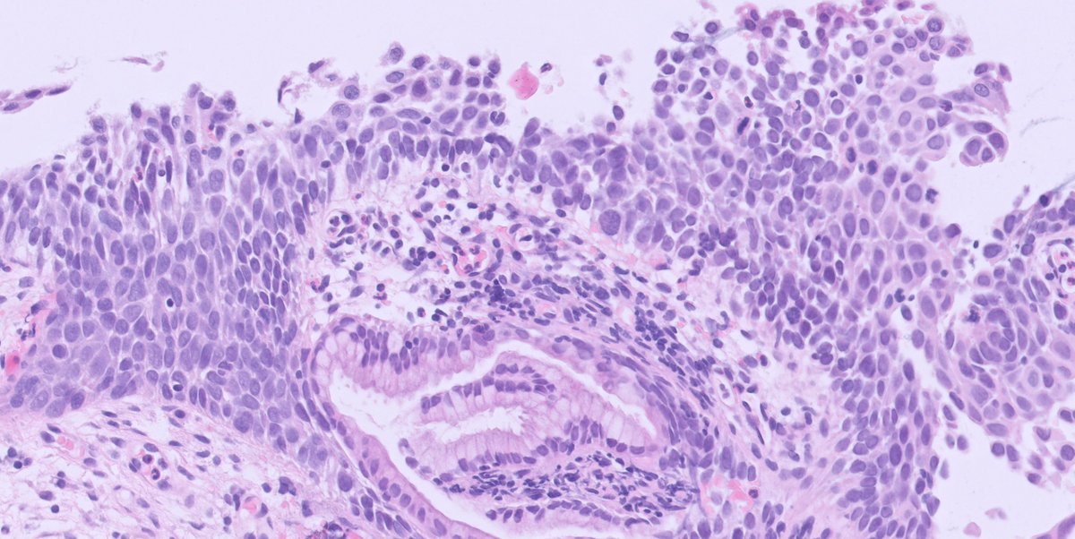 Another cervical biopsy...reported as LSIL...would you agree? Same biopsy at 2 levels 👇👇
#pathology #gynpath #PathTwitter