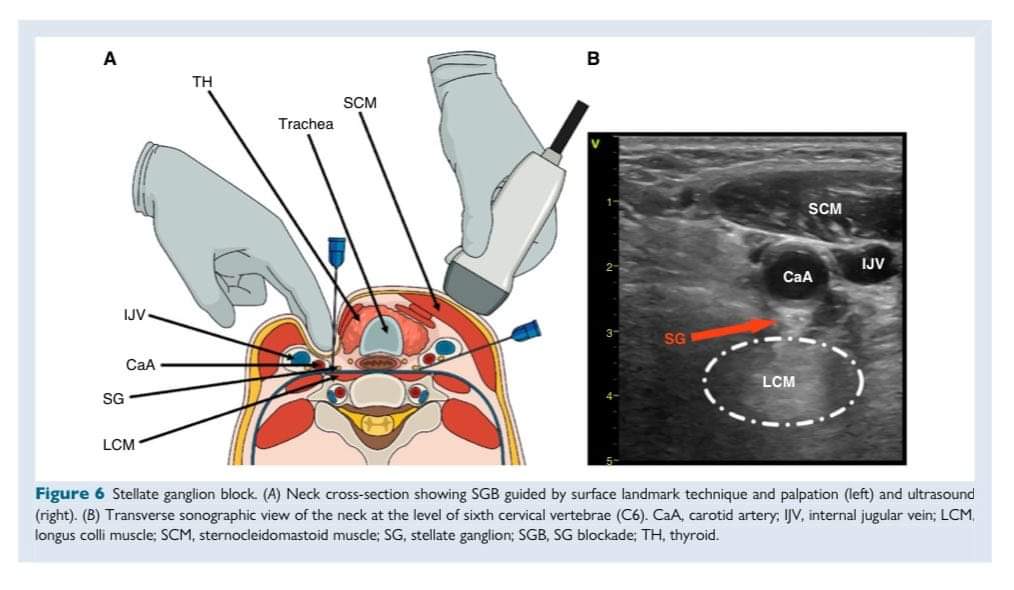 ZHeart11768530's tweet photo. 🔴 Management of patients with an electrical storm or clustered ventricular arrhythmias @ESC_Journals #openaccess 

https://t.co/K1KWKMr9oO
#CardioEd #Cardiology #EPeeps #EHRA2024 #meded #Cardiology #CardioTwitter https://t.co/iVCGwgsJi5