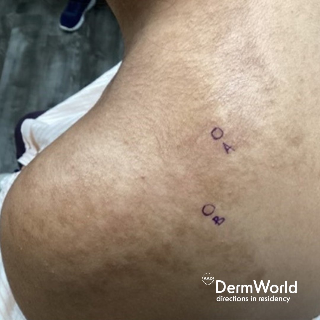 What's the #diagnosis? A 16-year-old Middle Eastern female with no past medical history presents with a complaint of skin discoloration, located on the left posterior neck for approximately three years. The patient reports that the discoloration... aad.org/member/educati…