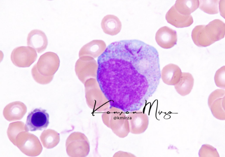 What's going on here? #hemepath #pathology #UMichPath kikoxp.com/posts/9490#com…