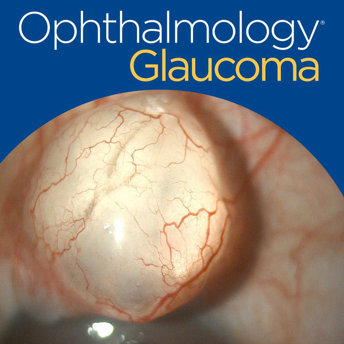 📣Registration is now open for the next Ophthalmology Virtual Journal Club! Join presenter Nazlee Zebardast, MD, and moderator @DrLorraineEyeMD for a discussion of “Optimal Performance of Selective Laser Trabeculoplasty” ow.ly/htoy50R9jow #Ophthalmology #Glaucoma