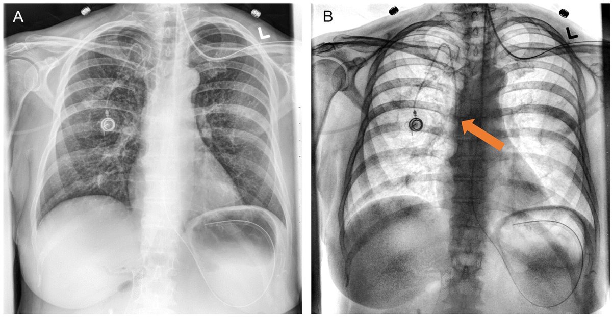 This recently published #openaccess research letter assesses the improved visibility of lines and tubes on portal dual-energy chest x-ray compared to conventional radiography: doi.org/10.1177/084653… @CARadiologists @UofTMedIm @SageJournals #radiology #radres