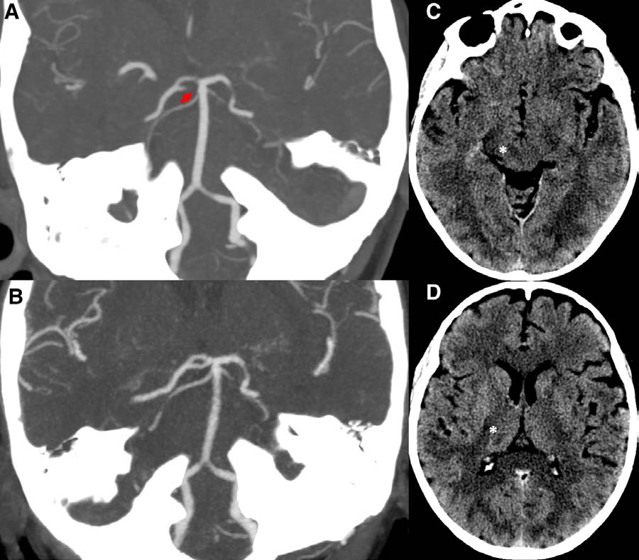 #Stroke Images: Fenestration of the P1 segment of the posterior cerebral artery and occlusion of one limb of the fenestration may be difficult to identify in the acute phase of stroke care. #AHAJournals ahajournals.org/doi/10.1161/ST… @MlzZedde