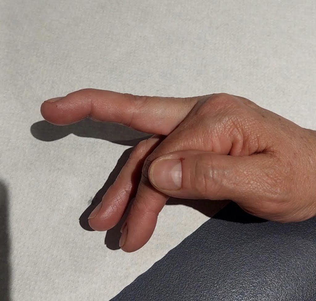 8/4/2024. An example of👆🔨Mallet #finger, a deformity in flexion of the distal interphalangeal joint, commonly caused by..
1⃣Distal phalanx fracture
2⃣Deep flexor tendon rupture
3⃣Extensor tendon mechanism lesion
4⃣Osteoarthritis
US ¬ XRAY Dx, coming tomorrow. 
#msk #radtwitter