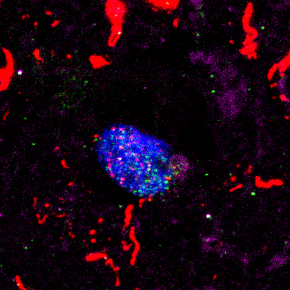 What is the contribution of hallmark and nuclear pathology to dementia associated DNA damage? Looking for a passionate post-doc to apply proteomic/immunochemical approaches to post-mortem tissue from dementia with Lewy bodies and Alzheimer’s disease. rb.gy/dr0819