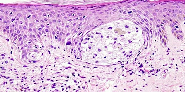 Neoadjuvant Dual vs Single Checkpoint Inhibitors in High-Risk Melanoma dlvr.it/T5F3Rw #ChronicDisease #Oncology