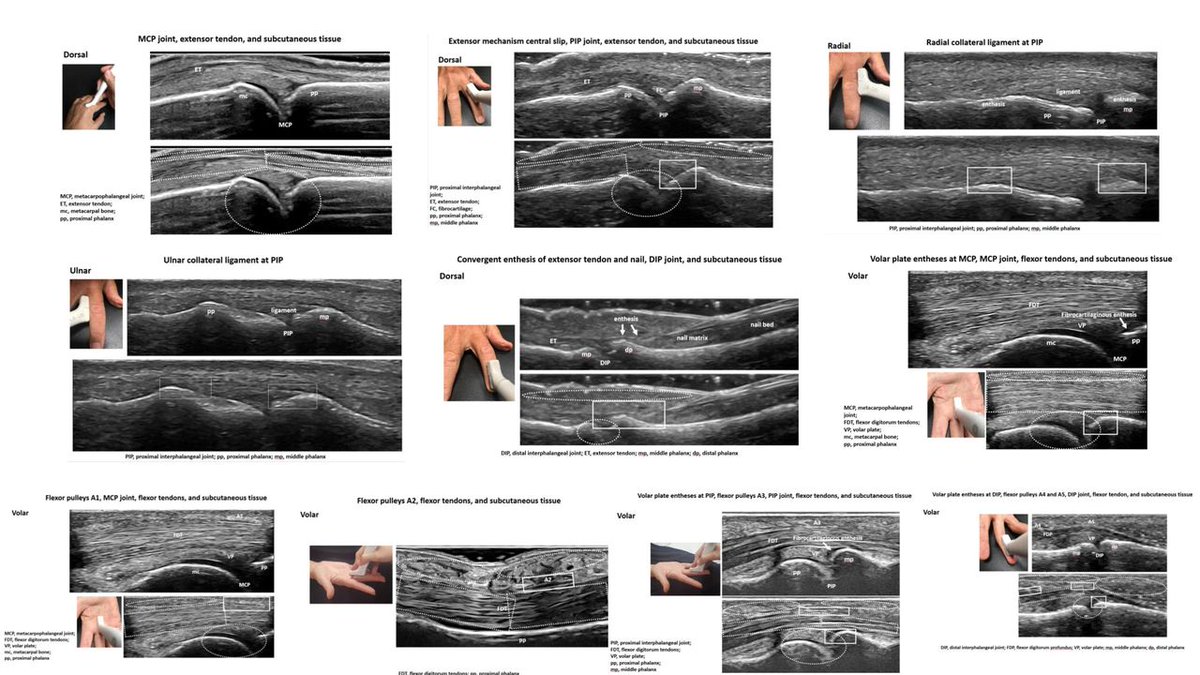 ✔️ The Outcome Measures in Rheumatology (#OMERACT) Ultrasound Working Group generated a consensus-driven ultrasound dactylitis score for psoriatic #arthritis😍🖐️ =GLobal OMERACT Ultrasound DActylitis Score (GLOUDAS)👍 see the details here 👉ard.bmj.com/content/early/…