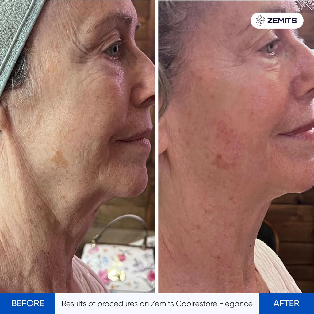 The Zemits CoolRestore Elegance machine, designed by doctors and engineers, offers advanced Cryo treatment for rejuvenated skin and reduced fat. Positive testimonials. See results photos. Available at DESUAR SPA. #facial #skinglow #skintreatment #skincarenatural #healthyskin