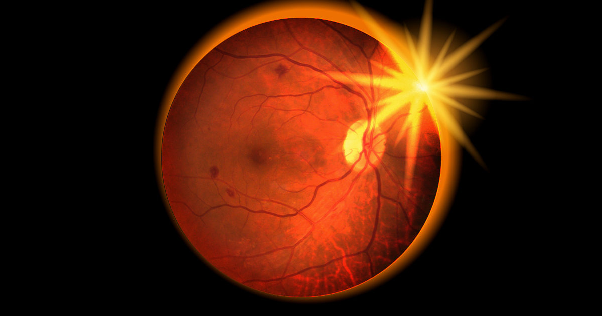 Diagnosis and management of solar retinopathy. Suspected cases of solar retinopathy may require urgent referral to an ophthalmologist for diagnosis, and to eliminate treatable causes for central visual disturbance. Read More: ow.ly/H1TE50QYSl5