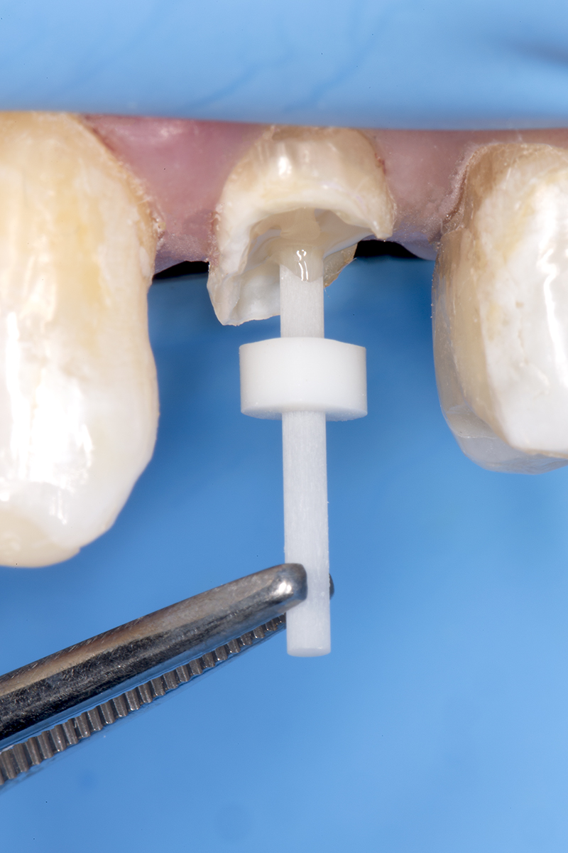 Don't miss part 2 of "A Novel Concept for Developing a Precise and Predictable Post and Core Complex Using the Injectable Resin Technique" with Drs. Douglas A. Terry, John O. Burgess, John M. Powers, and Editor in Chief Markus B. Blatz, DMD, PhD. Read it: bit.ly/CE20424