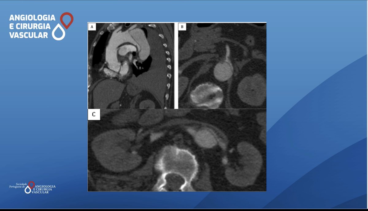 70-year-old, female went to ED  with acute abdominal pain, diarrhea and hematemesis. she was haemodinamic unstable and upper endoscopy was negative. CTA is below. After volume resuscitation and blood pressure control, persisted abdominal pain and hematochezias. What would you do?