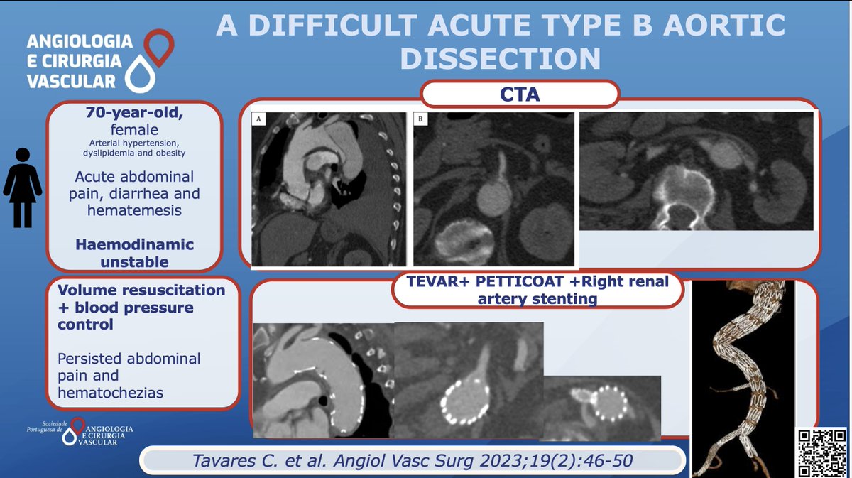 Here you can find the Endovascular solution chosen by Tavares C. et al
acvjournal.com/index.php/acv/…
#SPACV
#Vascularsurgery
#TypeBAcuteAorticDissection
#TEVAR
#PETICOAT

<a href="/EVST_ESVS/">European Vascular Surgeons in Training (EVST)</a> <a href="/ESVSmembership/">ESVS</a>  
<a href="/VascularSVS/">Society for Vascular Surgery</a> 
<a href="/VascularNews/">Vascular News</a>