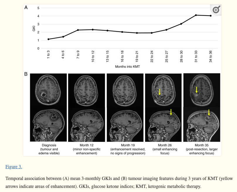 #Ketogenic #metabolic therapy in conjunction w/ standard treatment for #glioblastoma: A case report ncbi.nlm.nih.gov/pmc/articles/P… @_atanas_ @_INPST @ScienceCommuni2 @DHPSP @DominicDAgosti2 @ascarbs @MEATritionCom @CancerEvolves @DrPalmquist @MetabolicHConf @DrFeinman @tnseyfried…