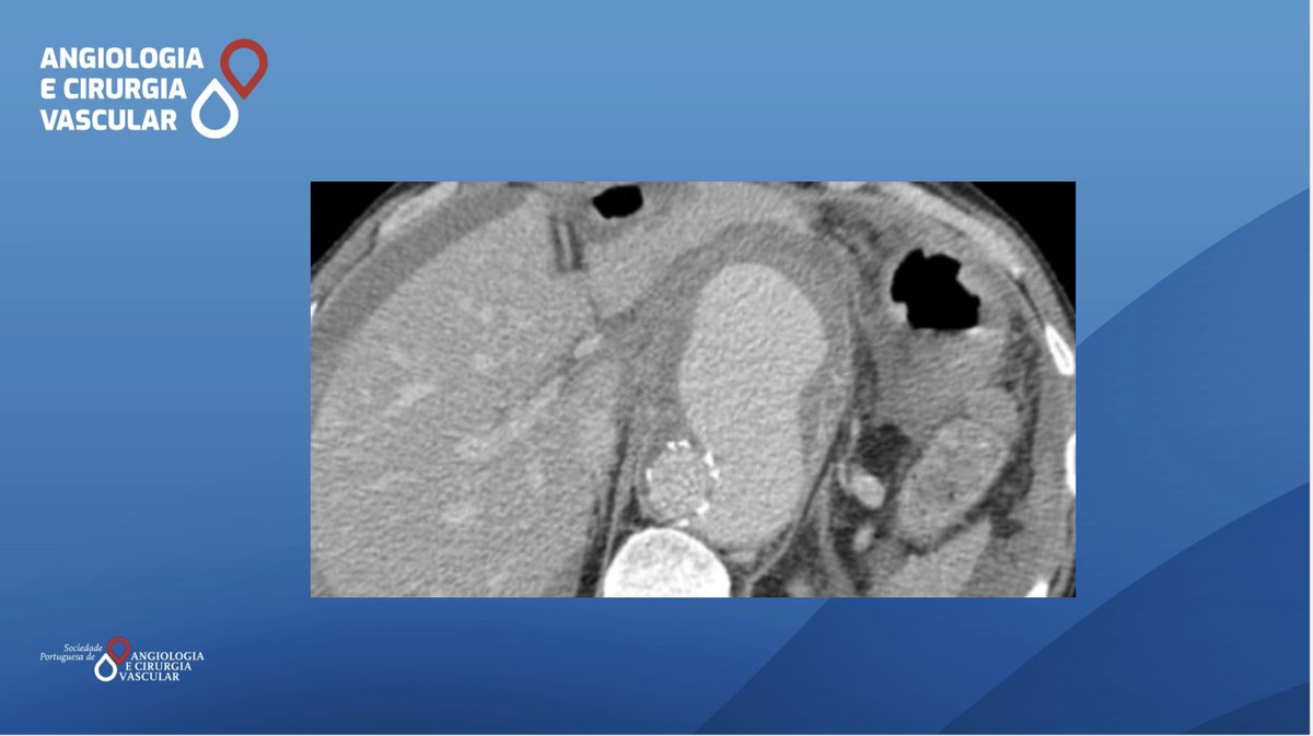 44-year-old, male. Previous history of  pseudoaneurysm involving left CIA+EIA and aortic paraceliac pseudoaneurysm treated with bypass from the left CIA to CFA and ​TEVAR deployed juxta SMA. 10 years later, presented  with epigastric pain.The CTA is below. What would you do now?
