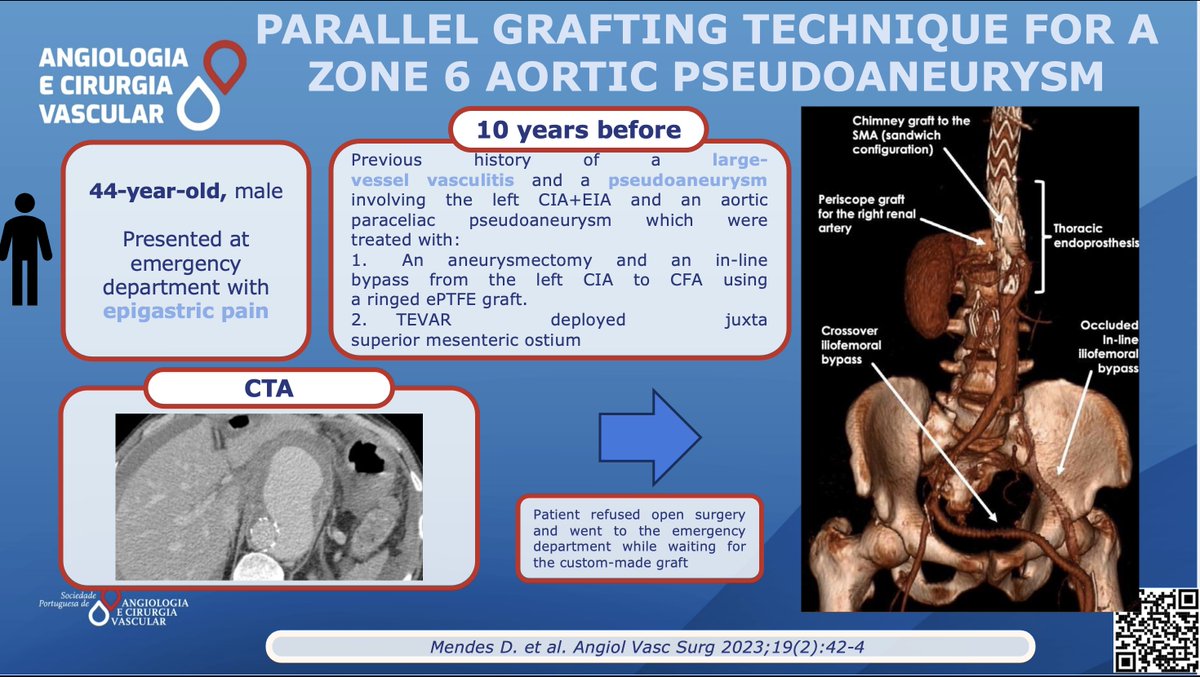 Mendes D. et al performed a parallel graft thechnique for a zone 6 aortic pseudoaneurysm. You can read more here lnkd.in/dPwgs6N8

#SPACV
#Vascularsurgery
<a href="/ESVSmembership/">ESVS</a>  
<a href="/EVST_ESVS/">European Vascular Surgeons in Training (EVST)</a> 
<a href="/VascularSVS/">Society for Vascular Surgery</a> 
<a href="/VascularNews/">Vascular News</a>