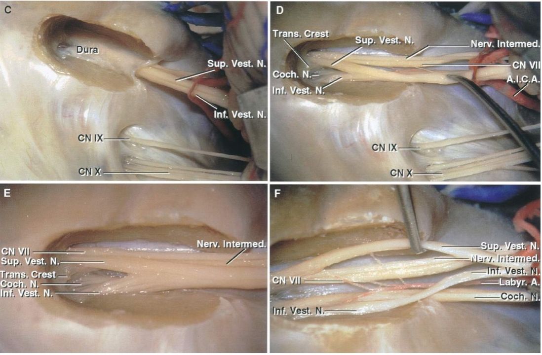 The cochlear nerve runs along the inferior aspect of CN VIII. The above images demonstrate the location of the vestibular nerves in relationship to the facial and cochlear nerves.

 #MedTwitter #Neurosurgery #NSGY #surgery