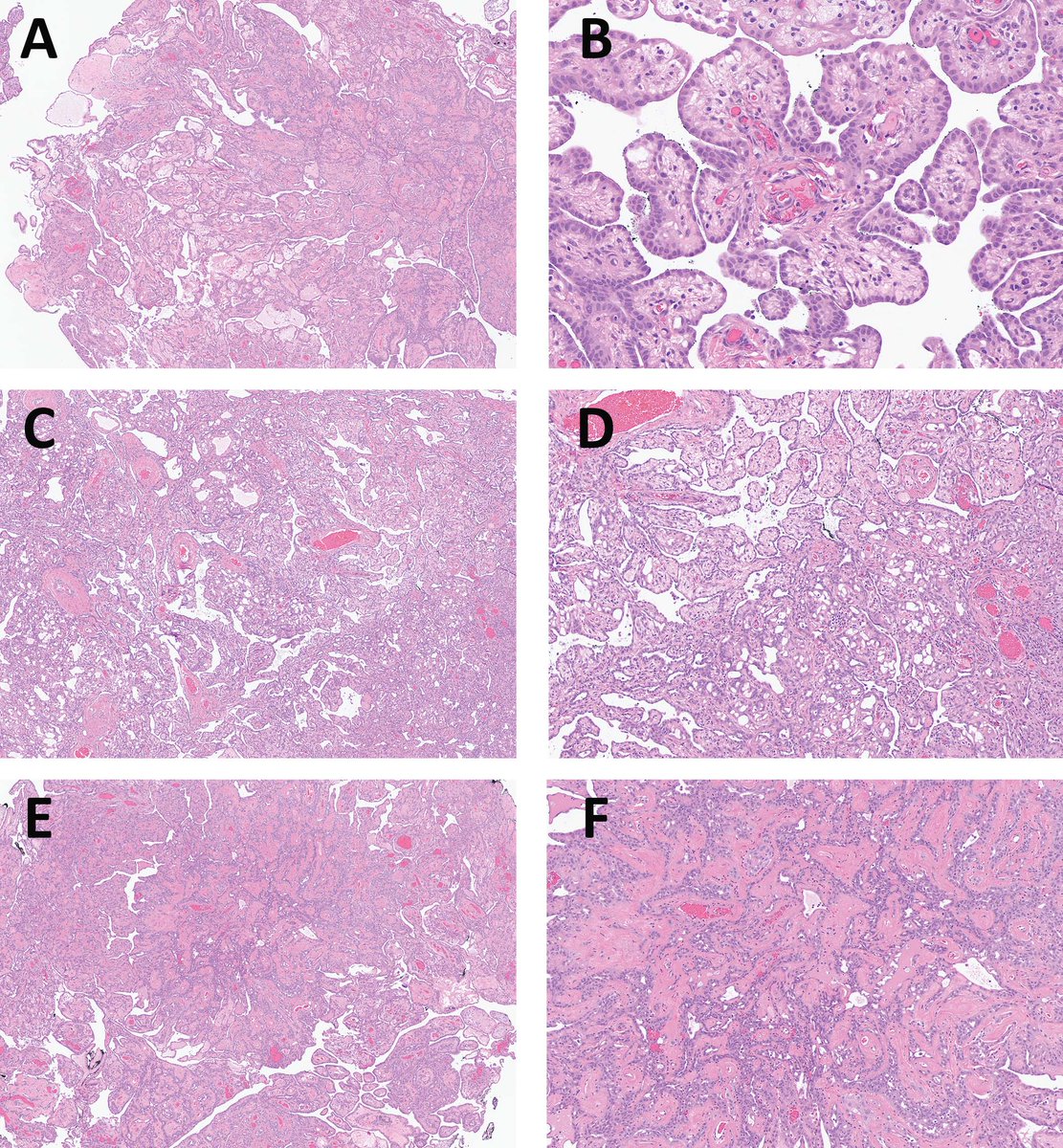 Strongly recommend working up complex mesothelial tumors of the tunica vaginalis for NF2 alterations in addition to BAP1 and CDKN2A/B. journals.lww.com/ajsp/abstract/…