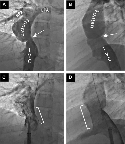 Might be the only author on this paper with Twitter so I will share. Transcatheter Interventions in ACHD. authors.elsevier.com/a/1iud37sv8qB4…