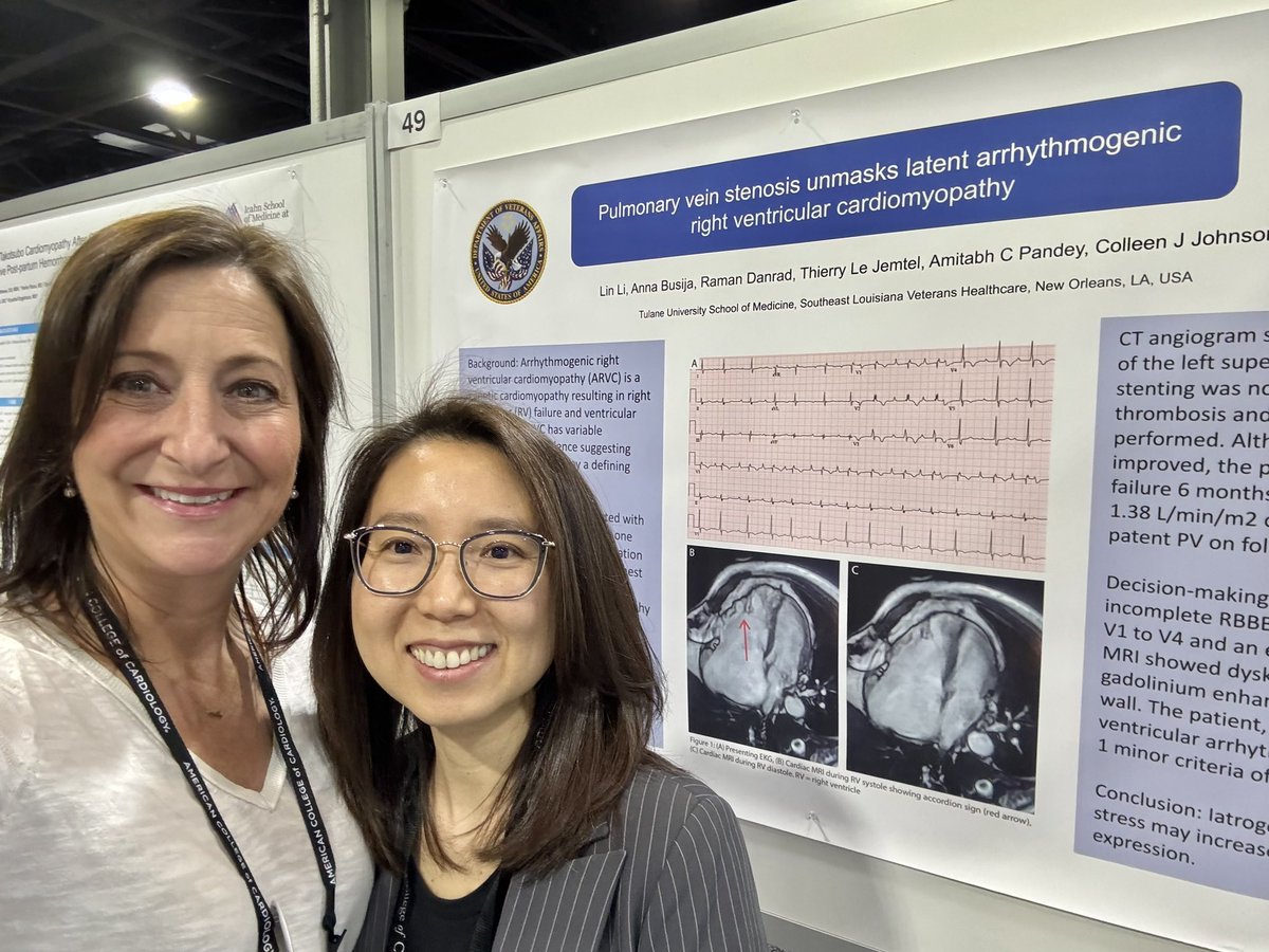 An interesting case of post PVI pulmonary vein stenosis unmasking ARVC presented by Lin Li, MD @Flyingamoi1 @AmitabhCPandey, Colleen Johnson, MD, FACC, Thierry LeJemtel, MD, FACC @TulaneCardio @JACCJournals @ACCinTouch #ACC24