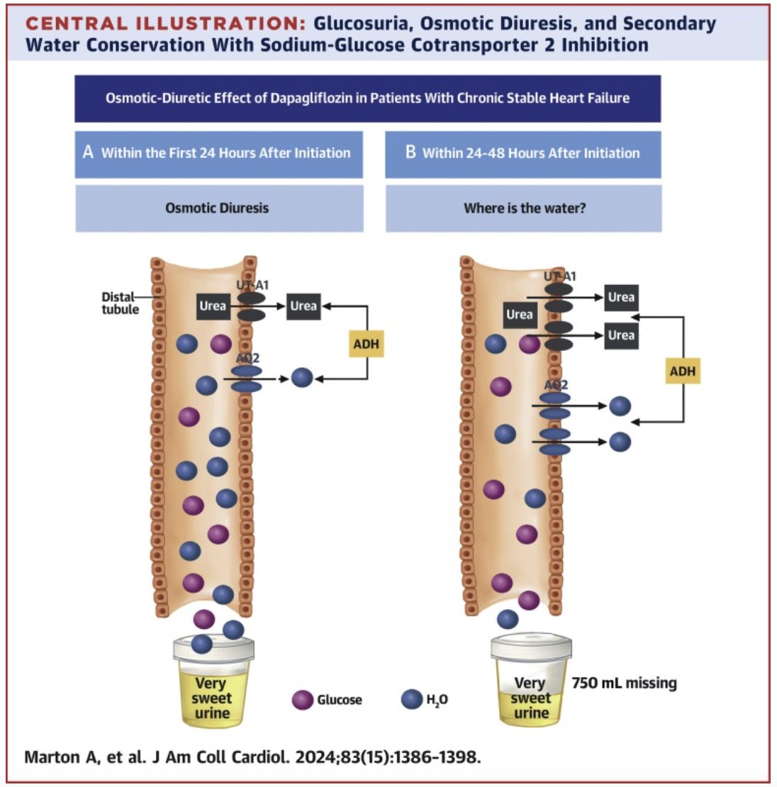 New from Dr Jens Titze and colleagues @dukeNUS in @JACCJournals Water Conservation Overrides Osmotic Diuresis During SGLT2 Inhibition in Patients With Heart Failure sciencedirect.com/science/articl…