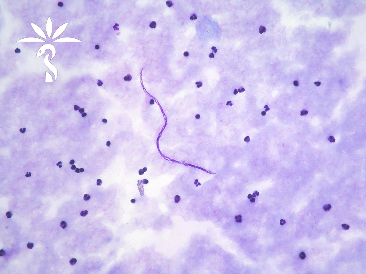 It’s time for more microfilariae with Idzi Potters and @ITMantwerp. The patient is from Brazil and is asymptomatic. The microfilariae are ~200 µm. parasitewonders.blogspot.com/2024/04/case-o… What is your ID? #mayopath #pathology #CrittersOnTwitter #PathBugs