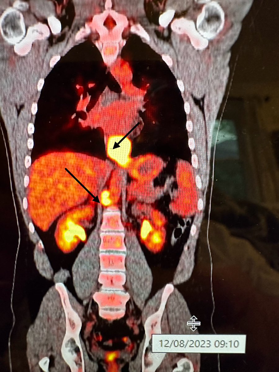 29 years old distal adenoca 12 cycles of FOLFOX plus immunotherapy (PDL 1 CPS >10) Excellent response on restaging PET. Planning LTA + D3 LN dissection @LFerri123 @ISDE_net @JournalofGISurg