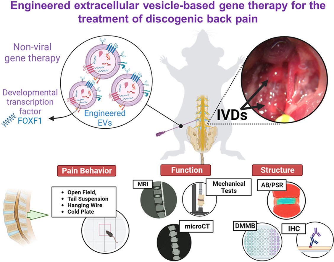 Engineered extracellular vesicle-based gene therapy for the treatment of discogenic back pain ! sciencedirect.com/science/articl…