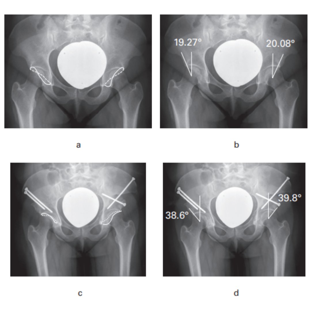 After 26 periacetabular osteotomy procedures, a significant drop in surgical time was observed and a plateau was also achieved. #Osteotomy #BJJ #Surgery ow.ly/7hIC50R7uly