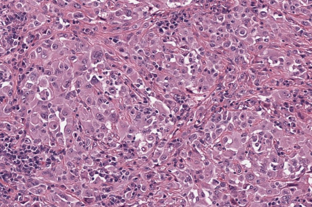 I am + for Calretinin, WT1 and CK5/6

I am - for TTF1, Claudin and MOC31

I can have loss of BAP1 and homozygous deletion of CDKN2A

Who am I?

Credit: Kelly Hall, MD

#pathagonia #path4people #pathtwitter #pathx #pathology #pulmpath #medx #pulmonology #hemeonc #medicine #CTsurg