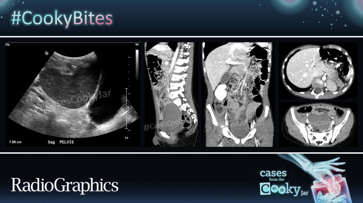 11-year-old boy with 3⃣ days of worsening pelvic pain; history of multiple congenital 🫀 defects. What is the diagnosis❓ We’ll post the answer in 24h. Share companion cases with us using #CookyBites #158. We will RT the best cases! #RGphx @cookyscan1 @RadioGraphics