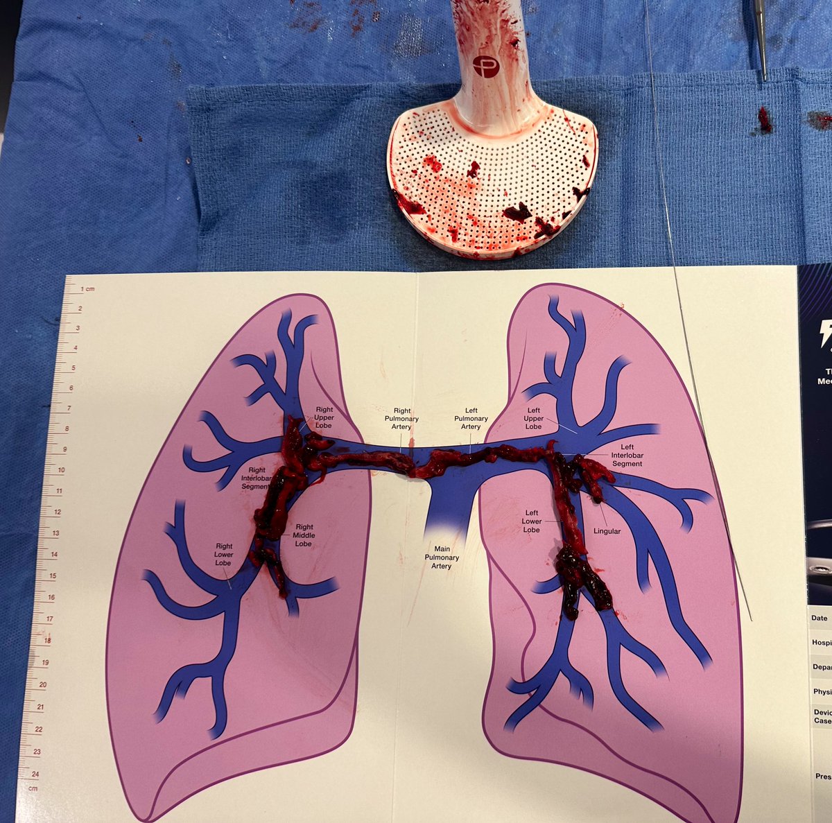 During totality 🌑🌒, we experienced our own total eclipse of the heart (or pulmonary arteries) and treated in a Flash ⚡️ <a href="/PenVascular/">Penumbra Vascular</a>