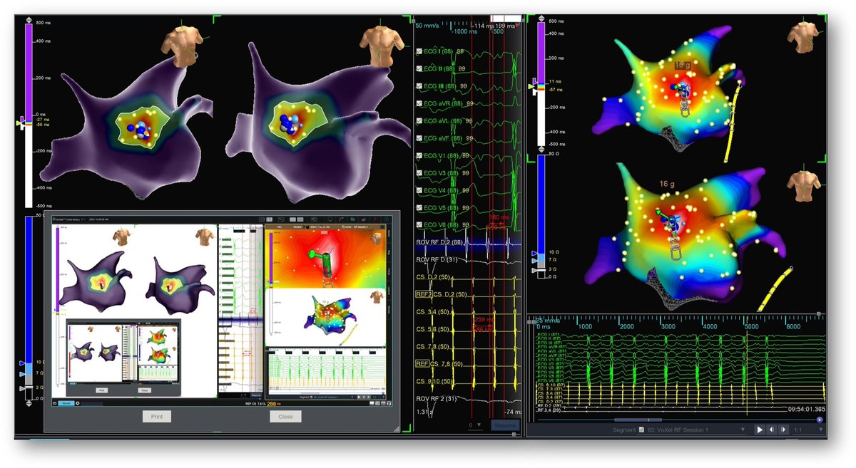 Patient presented with stable 260 msec incessant tachycardia. Unusual P-Wave to be localized to LA side of Bachmann's Bundle insertion for this seemingly centrifugal / microreentrant AT. Prior CTI only. @JeffHsingMD @JNctionals @AbbottCardio #SVT #PMA #TactiFlex