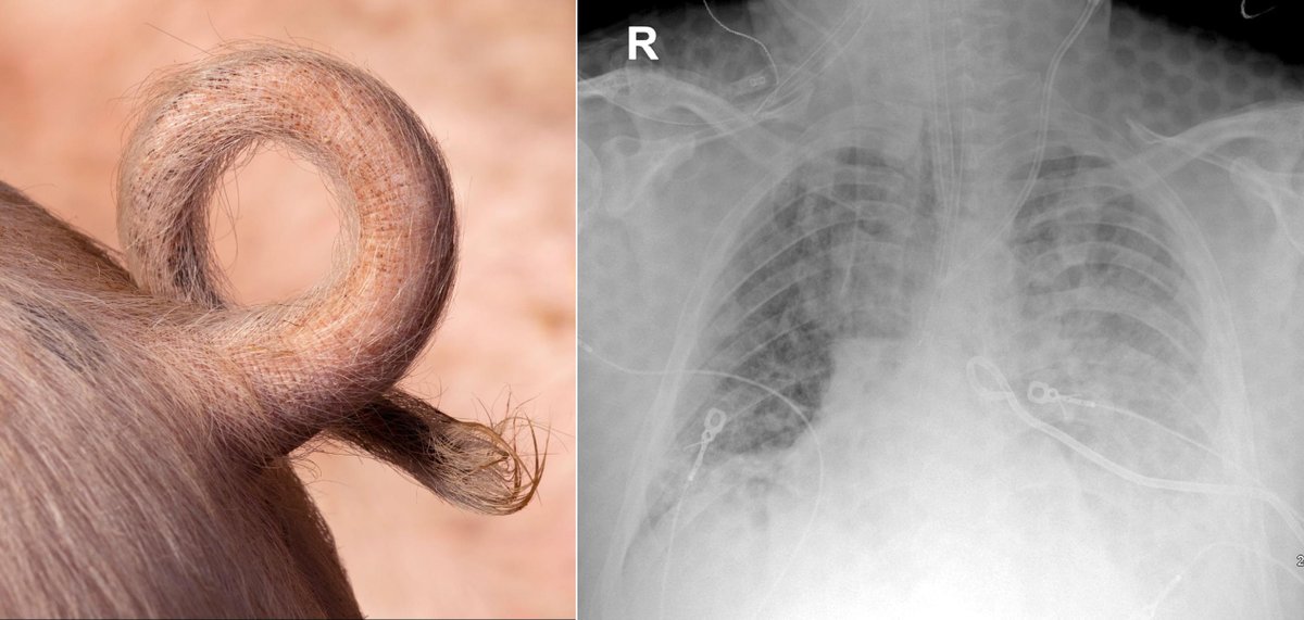 Pigtail catheter for pleural drainage: Tips to minimize complications A scary case and an excellent review on minimizing complications with small-bore tube thoracostomies by Drs. Sandall, Truitt, & Cambron from @CHRISTUSHealth ALiEM.com/pigtail-cathet…