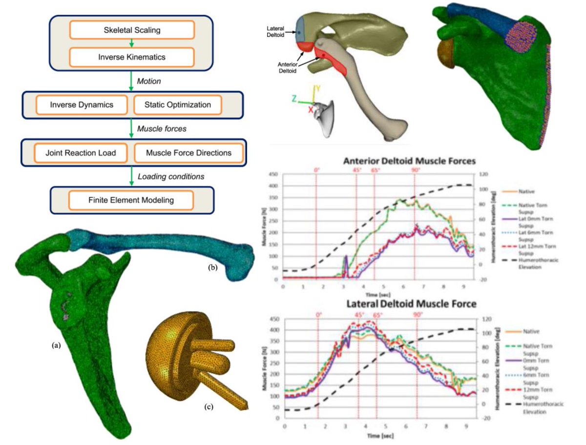 medntdj's tweet image. The evaluation of reverse shoulder lateralization on deltoid forces and scapular fracture risk: A computational study doi.org/10.1016/j.medn……… #ComputationalModeling #Lateralization #ScapularFracture #MedTwitter #scicomm #MedEd #AcademicTwitter