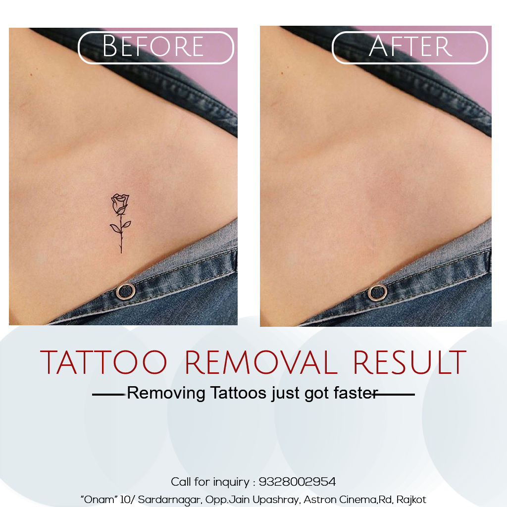One of the Top #TattooRemovalTreatmentinRajkot at #parlicosmeticrajkot

Book your Appointment now for #tattooremovaltreatment @ parlicosmeticrajkot.com/permanent-tatt…

For More Inquiry Call: - 9328002954

#laserremoval
#lasertattooremoval
#lasertattooremovals
#lasertreatment
#lasertreatments
