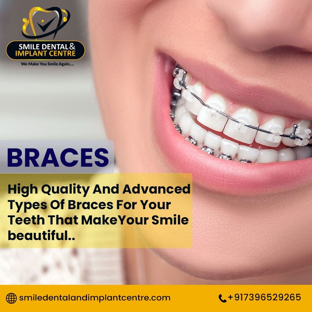 High Quality and Advanced Types of #Braces for Your #Teeth That Make Your #Smile Beautiful. 
Get a #20%Discount on Braces now at #SmileDentalandImplantCentre in #Kapra, #Ecil, #A.S.RaoNagar, #Hyderabad.
👉 For an Appointment call us at +91-7396529265, 9490618635.

#straightteeth