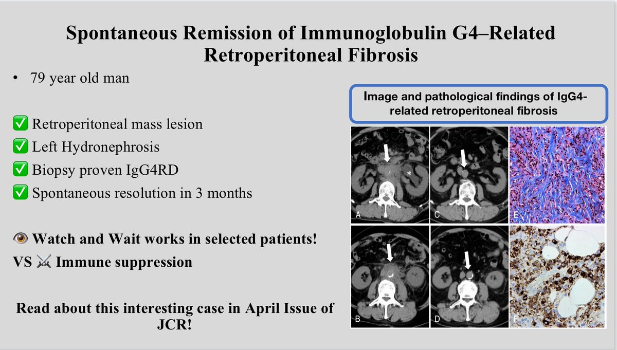 79 year old man ✅ Retroperitoneal mass lesion ✅ Left Hydronephrosis ✅ Biopsy proven IgG4RD ✅Spontaneous resolution in 3 months 👁️ Watch and Wait works in selected patients! VS ⚔️Immune suppression In April Issue of JCR! tinyurl.com/mr2c38z3