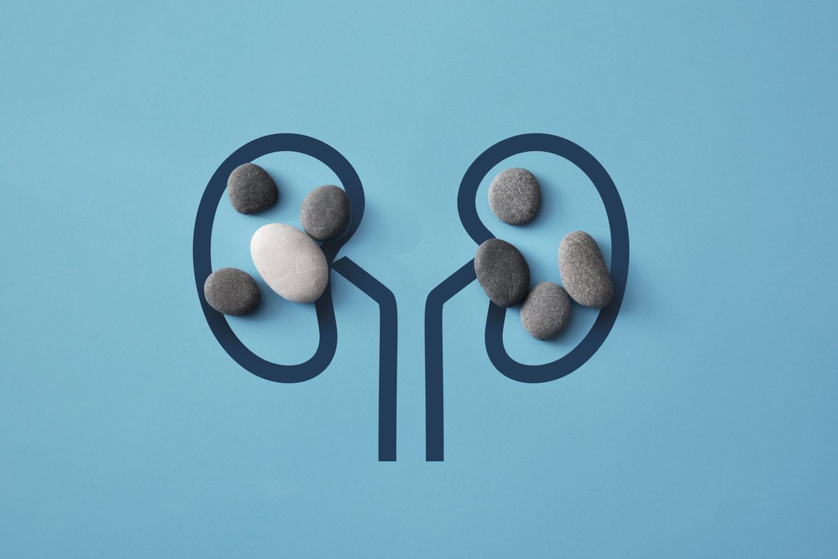 New Study led by #InselGruppe and @unibern shows: a significant portion of kidney stone patients have a monogenic cause, greatly impacting treatment options. Read more: academic.oup.com/ndt/advance-ar… #KidneyStoneResearch #Genetics @Dan_Fuster @MedFacultyUniBE