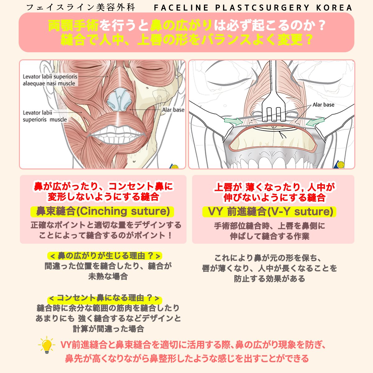 🟣#両顎手術を行うと鼻の広がりは必ず起こるのか？ 🟣#両顎後縫合で上唇を拡大して人中が短くなるように可能? 🟣#両顎後縫合で鼻先手術ように鼻の筋肉の操作も可能？  🟥両顎手術後、通常鼻が広がる理由は? ▶️術後, 筋肉の縫合に関する問題で生じる副作用 🌺【両顎時、鼻 ..., image size:1200x1200