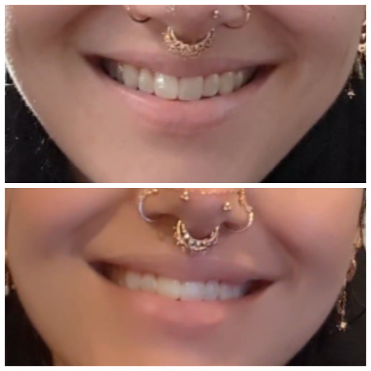 I got a lip flip 11 days ago and I'm soooo happy with the result. My top lip is like double the size it was before when I smile. I never had a gummy smile but it was pretty toothy and I feel like it's way more balanced now