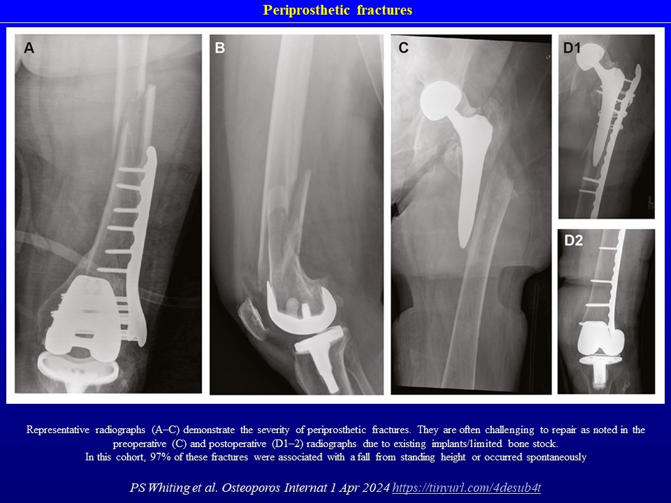 Periprosthetic fractures are generally osteoporosis-related. Medical record data prior to these fractures demonstrate the missed opportunity for osteoporosis diagnosis and treatment. PS Whiting et al. Osteoporos Internat 1 Apr 2024 tinyurl.com/4desub4t  …results single center