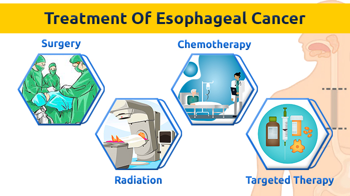 Esophageal cancer treatment options include surgery, chemotherapy, radiation therapy, targeted therapy, immunotherapy, and palliative care. Treatment plans are personalized based on individual needs. #EsophagealCancerAwareness