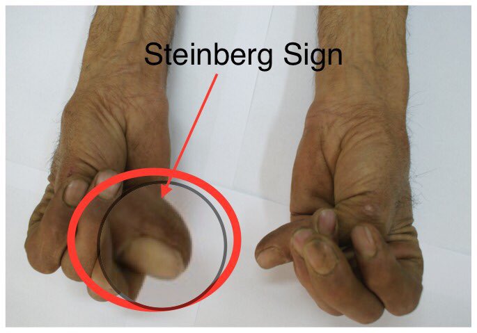 ➡️ Thumb overlaps the fifth finger when grasping the contralateral wrist #Wrist_Sign #Walker_Murdoch_Sign ➡️Thumb extends well beyond the ulnar border of the hand when overlapped by the fingers #Thumb_Sign or #Steinberg_Sign ✅Arachnodactyly 🔺Marfan’s Syndrome