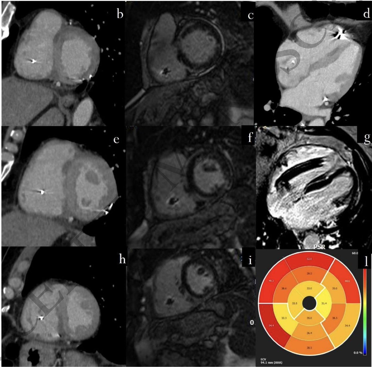 ESC_Journals's tweet image. Focus on #sarcoidosis diagnosis from a monomorphic #VT 👇
#MultimodalityImaging was key for diagnosis. #CT &amp;amp; #MRI &amp;amp; #PET -&amp;gt; Magic 3 for better definition.bit.ly/4avihgH @Steph_Achenbach @rafavidalperez @echo_stepbystep @denisamuraru @iamritu #EHJIMP #echofirst