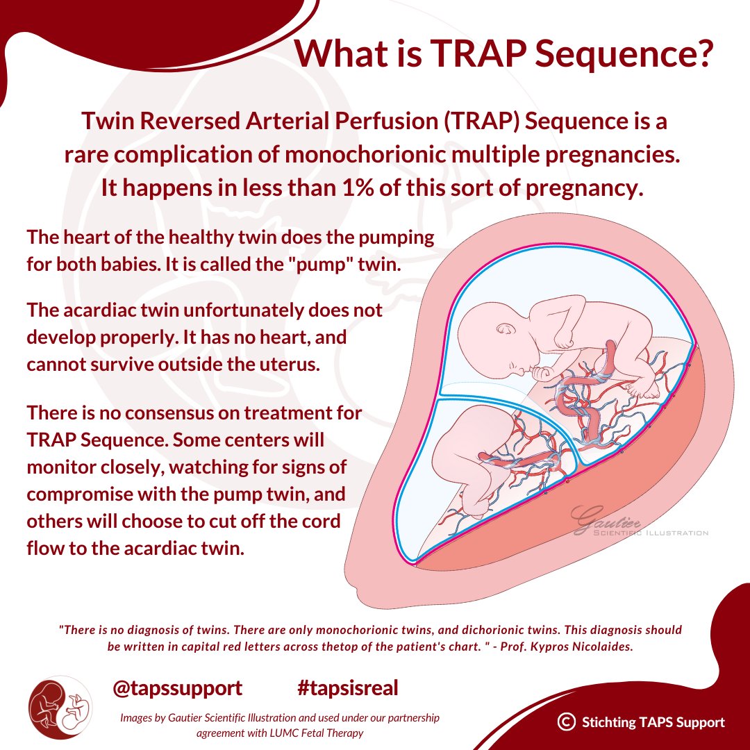 A rare complication of monochorionic twins is called TRAP sequence. Twin Reversed Arterial Perfusion (TRAP) Sequence happens in less than 1% of these pregnancies. Learn more: bit.ly/3qQPnlN #tapssupport #tapsisreal #trapsequence